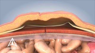 Ventral Hernia Repair  3D Medical Animation [upl. by Amsirak]