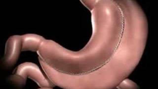 Laparoscopic Vertical Sleeve Gastrectomy by Marc Zare MD [upl. by Melodee]