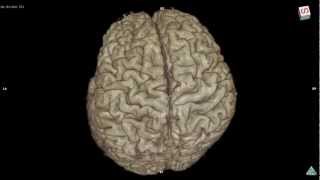 Variation of brain cortex 3D MRI sample Bgo [upl. by Theodora]