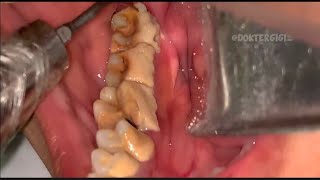 Tartar removal teeth at home  Tartar removal teeth at home [upl. by Lletram885]