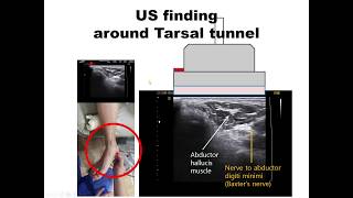 140의사용Dx amp Tx under USLecture Tarsal tunnel syndrome 족근관증후군과 주사 Kang’s method 강찬충남대Chan [upl. by Niarda]