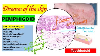 Pemphigoid Causes pathogenesis Types Histopathology Treatment  Pemphigus vs Pemphigoid [upl. by Arriec240]