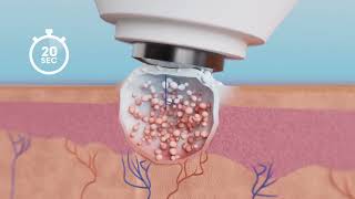 Dr Yglo Wart and Verruca Freeze Treatment  Fast easy and effective [upl. by Seugram]