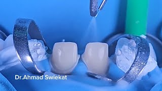 how to Do Cementation for Venners under rubber Dam [upl. by Sandi]