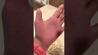 Hands Shave Left Hand  Feb 22 2023  Epidermolytic Palmoplantar Keratoderma EPPK Hyperkeratosis [upl. by Ratep]