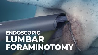 What is Endoscopic Lumbar Foraminotomy  Atlantic Spine Center [upl. by Fraya986]