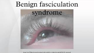 Benign fasciculation syndrome [upl. by Tloh]