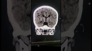 Corpus Callosum Agenesis  Radiology [upl. by Anton]