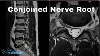 How to detect conjoined lumbosacral nerve roots on MRI [upl. by Ellebana]