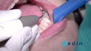 Ultrasoon reinigen bij parodontitis  Edin Dental Academy [upl. by Ardnosal]