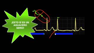 CURSO DE ELECTROCARDIOGRAFIA 47  EXTRASÍSTOLES SUPRAVENTRICULARES [upl. by Airad374]