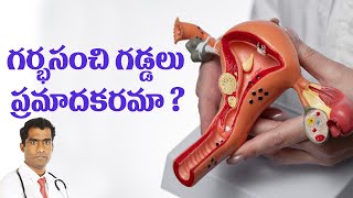 గర్భసంచి గడ్డలు ప్రమాదకరమా  Are uterinefibroids dangerous [upl. by Etnoval]