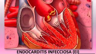 ENDOCARDITIS INFECCIOSA [upl. by Isman]