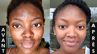 L ACNÉ COMMENT s en DÉBARRASSER 3 PRODUITS contre les boutons et les tâches🔥  SKINCARE ROUTINE💦 [upl. by Nylkcaj839]