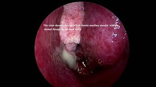 Left sided chronic maxillary sinusitis with pus [upl. by Farkas]