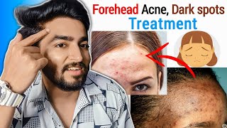 Forehead Acne Pimples Blackheads and Darkspots Treatment [upl. by Murdocca]