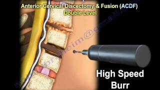 Cervical Spine Decompression And Fusion   Everything You Need To Know  Dr Nabil Ebraheim [upl. by Mcconaghy709]