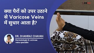 Does Elevating Legs Help Varicose Veins  VeinMD Pune [upl. by Rovelli]