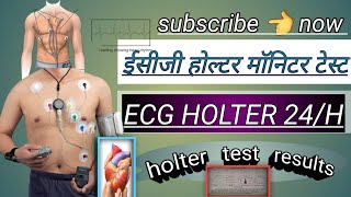 ecg holter monitor test  holter test results  holter monitor 24 hoursheart holter testviral [upl. by Dahle]