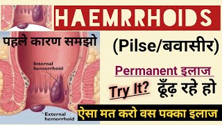 Haemorrhoids Pilesबवासीर पाइल्स क्यों होता है बवासीर के कारण In Hindi [upl. by Dempsey]