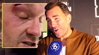 TYSON FURY GOT SOMEONE TO CUT HIM RIDICULOUS  Eddie Hearn REACTS to postponement [upl. by Chrysler]