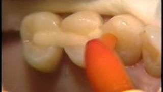 Posterior Periodontal Splint [upl. by Truman]