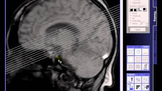 Brain MRI Diperiventrikulerlacunar infarction left ventricular lateral [upl. by Hgielrac]