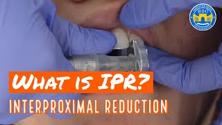 Interproximal Reduction IPR on Teeth for Braces and Invisalign [upl. by Revolc]