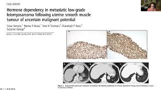 LMSDR Webinar Role of Estrogen Suppression in Uterine Leiomyosarcoma [upl. by Jerz412]