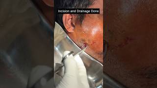 Buccal Space infection Management incisionanddrainage abscess surgeon surgicaleducation medical [upl. by Oiretule249]