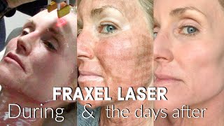 My FRACTIONAL CO2 LASER Experience  The FULL Treatment amp the DAYS following  BEFORE amp AFTER Fraxel [upl. by Wes]