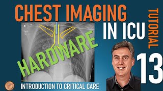 Chest Imaging in ICU  Part 2  Hardware [upl. by Stockmon813]