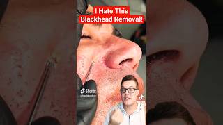 Dangerous BLACKHEAD REMOVAL  Dont Use This Tool shorts [upl. by Kcirret]