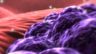 Nanobiotix nanomedicine for cancer treatment [upl. by Archie]