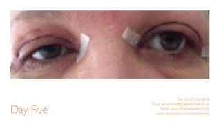 Eyelid Surgery at La Belle Forme [upl. by Rooker]