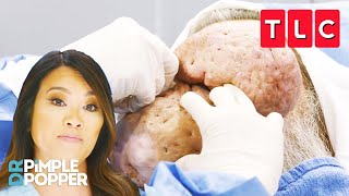 Dr Lee Treats The Largest Nasal Growths Shes Ever Seen  Dr Pimple Popper  TLC [upl. by Paik]