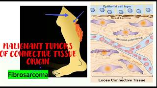 Fibrosarcoma Malignant neoplasms of connective tissue [upl. by Mossberg]