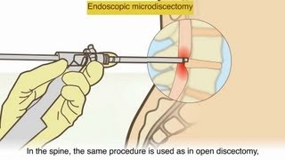 A herniated disc  What is it and what surgical treatments are available [upl. by Sredna20]