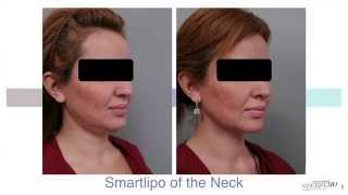 Double Chin Liposuction With Smartlipo™  Dr Sterry Explains [upl. by Larena]