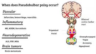 Bulbar vs pseudobulbar palsy [upl. by Einnaf]