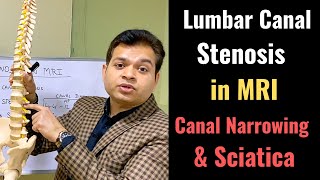 Secondary Canal Stenosis Foraminal Stenosis Stenosis of the Spine in MRI Sciatica MRI PART 2 [upl. by Lind]