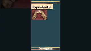 Hyperdontia [upl. by Nidnerb]