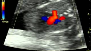 large right atrium fetal heart at 19 weeks [upl. by Particia]