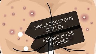 1 seul élément pour éliminer les boutons avoir les fesses et larrière des cuisses lisses [upl. by Jasmina]