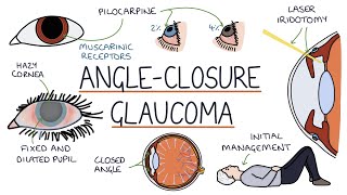 Understanding Acute Angle Closure Glaucoma [upl. by Andrew]