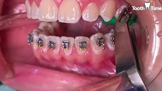 How they put braces on  13 years old patient  Tooth Time Family Dentistry New Braunfels Texas [upl. by Eilyw]