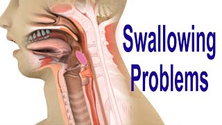 Swallowing Problems or Dysphagia Top 4 Possible Causes Including Cricopharyngeal Dysfunction CPD [upl. by Nylinej973]