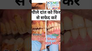 पीले दांत को फिर से सफेद करें teethwhitening teethfilling stainteeth dentalcap yellowteeth drr [upl. by Spratt]