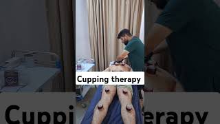 cupping therapy for back pain [upl. by Icats981]