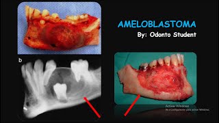 Ameloblastoma Etiología Características  Clínicas Radiográficas Histológicas y Tratamiento [upl. by Nnaynaffit]